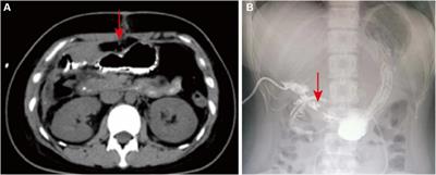 Purse-string suture with nylon cords and metal clips for the treatment of duodenal fistulae under the endoscope: a case report